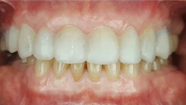 Después: sonrisa rehabilitada con coronas dentales de forma y color natural