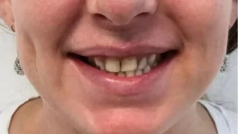 Antes: sonrisa con dientes desalineados y desgastados