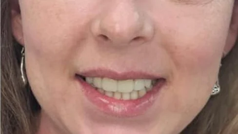 Después: sonrisa alineada y pareja tras el diseño de sonrisa