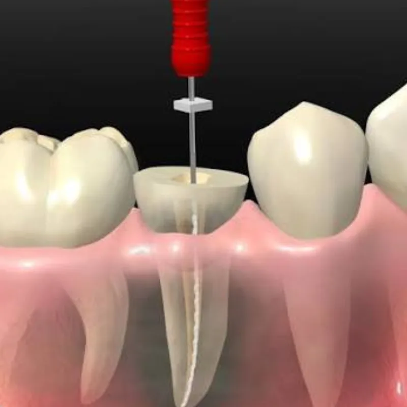 Ilustración 3D de un tratamiento de conducto (endodoncia) en un molar