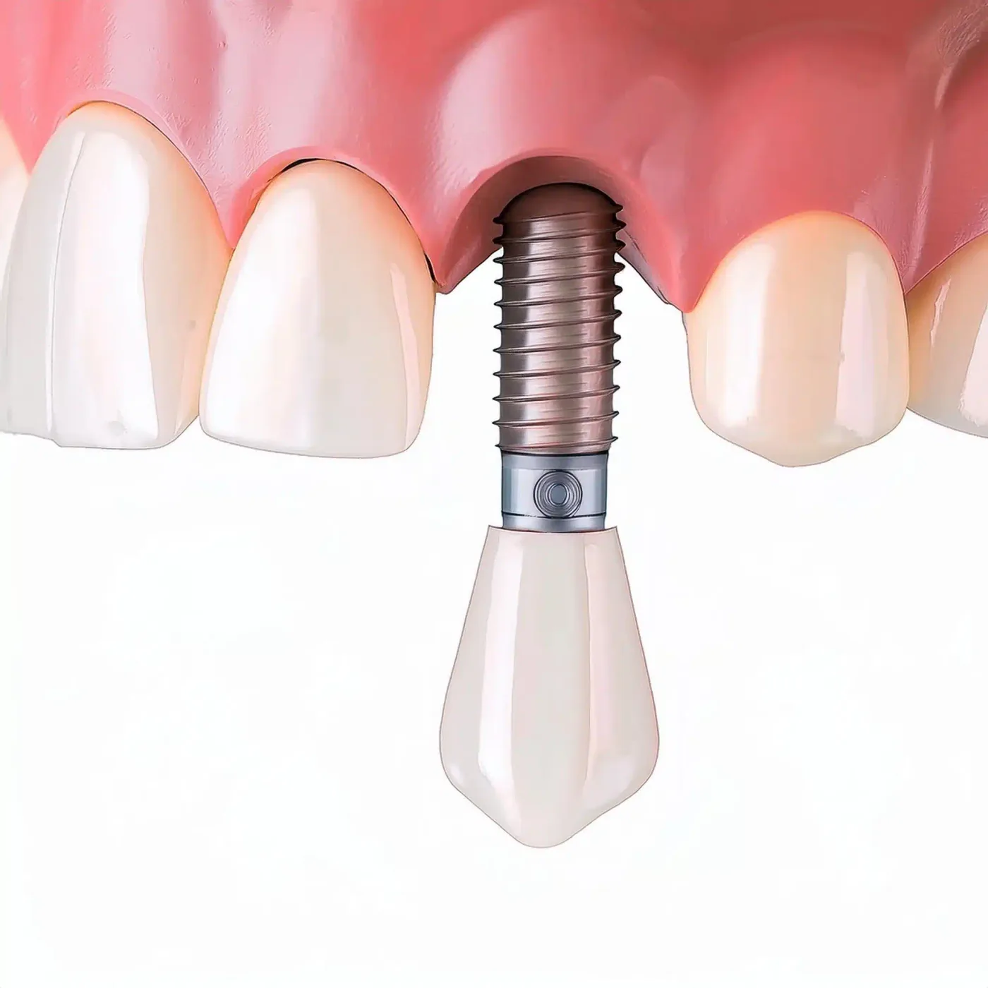 Ilustración 3D de un implante dental de titanio integrado al hueso, con corona