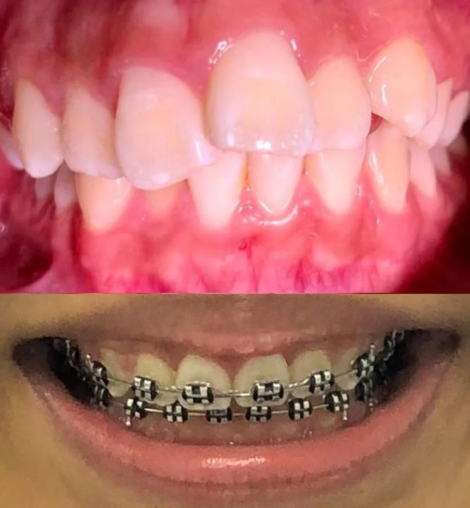 Paciente con brackets de ortodoncia convencional en Mazatlán