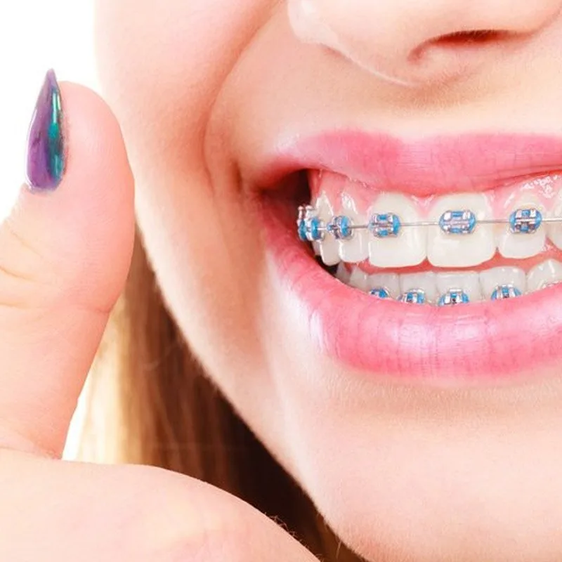 Ortodoncia convencional con brackets metálicos