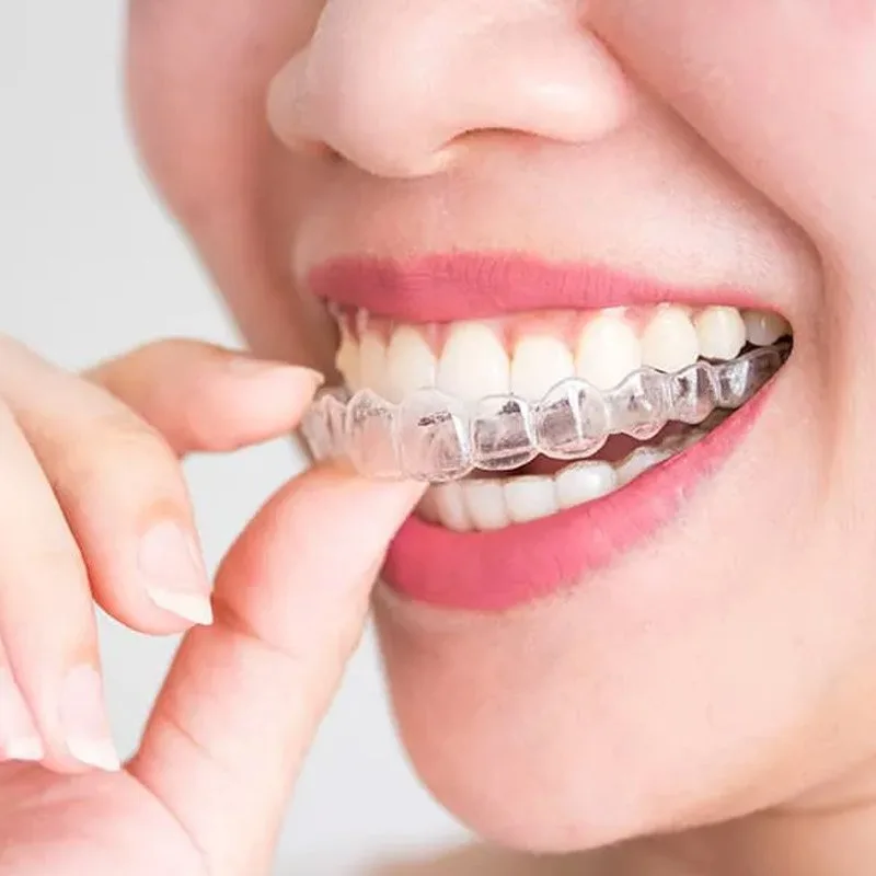 Ortodoncia invisible con alineadores transparentes