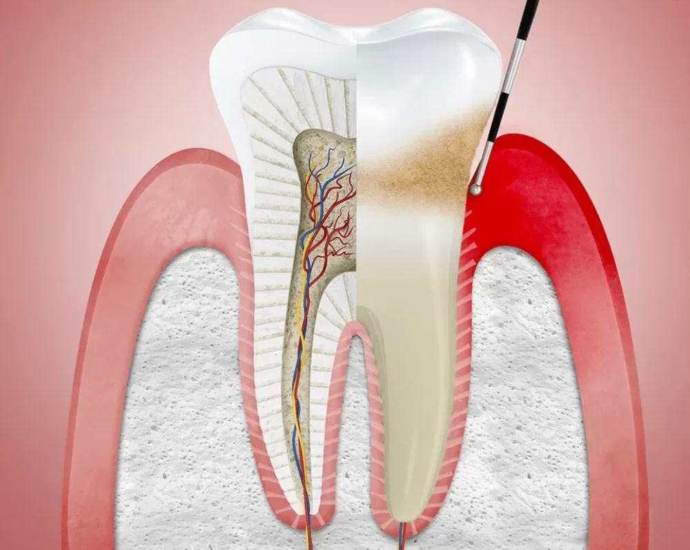 Tratamiento de periodoncia y salud de encías en Mazatlán Tratamiento de periodoncia y salud de encías en Mazatlán