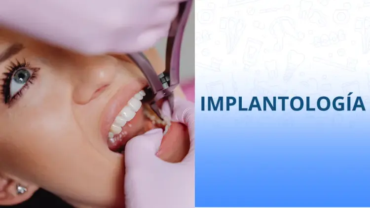 Implantología dental en Mazatlán Implantología dental en Mazatlán